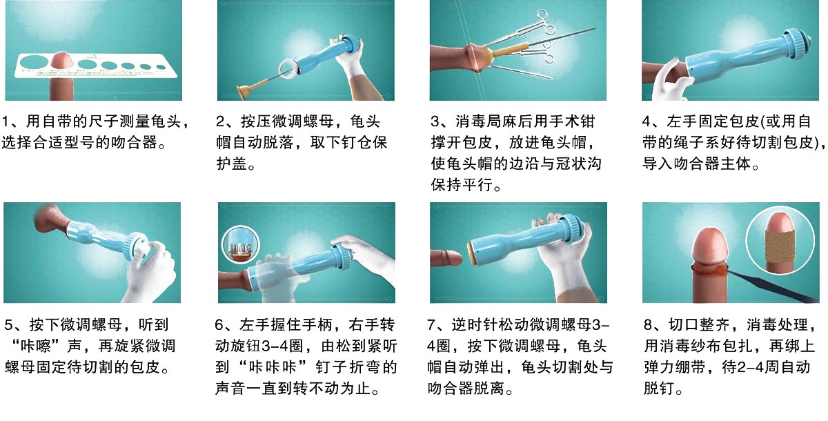 一次性使用包皮切割吻合器